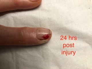 24 hours post injury